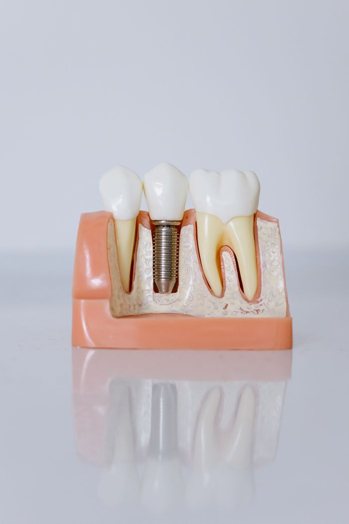 hero-img-02 Detailed view of a dental implant model showcasing teeth and gum anatomy for dental education.