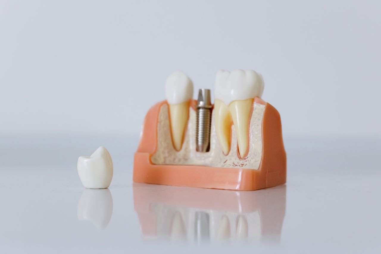 hero-img-01 Close-up of a dental implant model featuring artificial teeth and jaw structure.