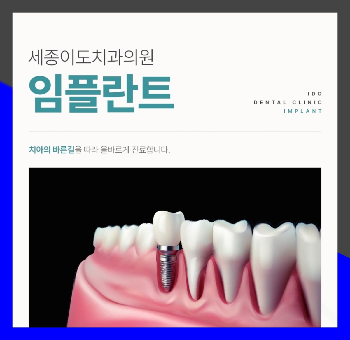 세종시임플란트 오래 사용하기 위해 확인해야 할 점 세종시임플란트 오래 사용하기 위해 확인해야 할 점