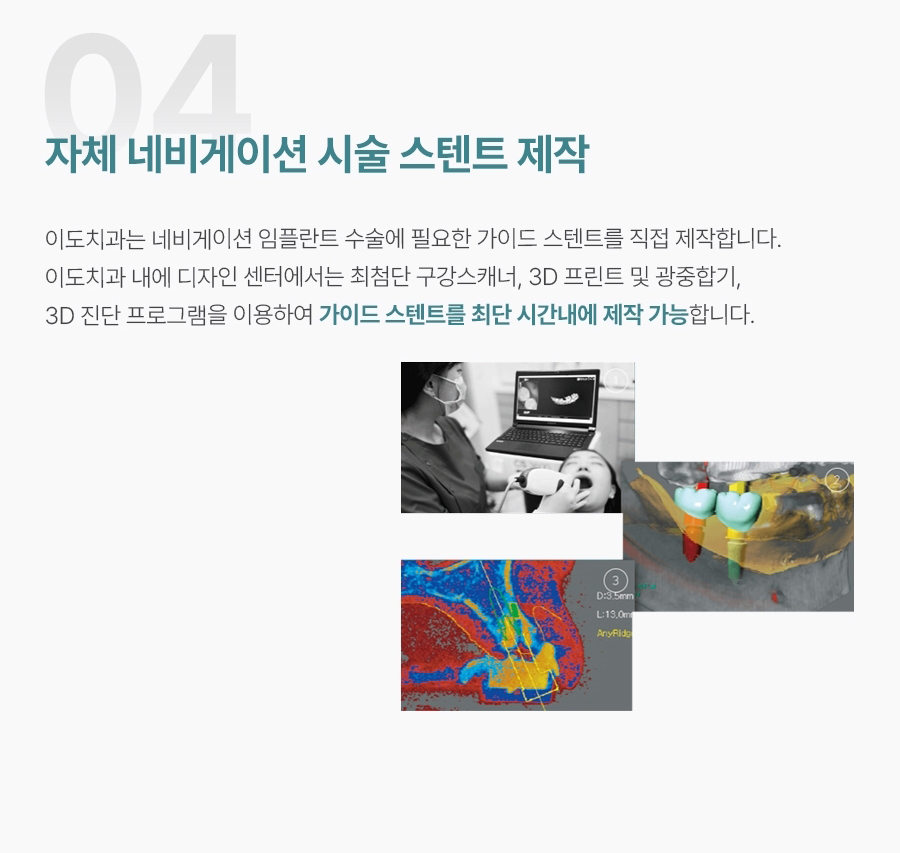 세종이도치과 임플란트 이미지 (5)
