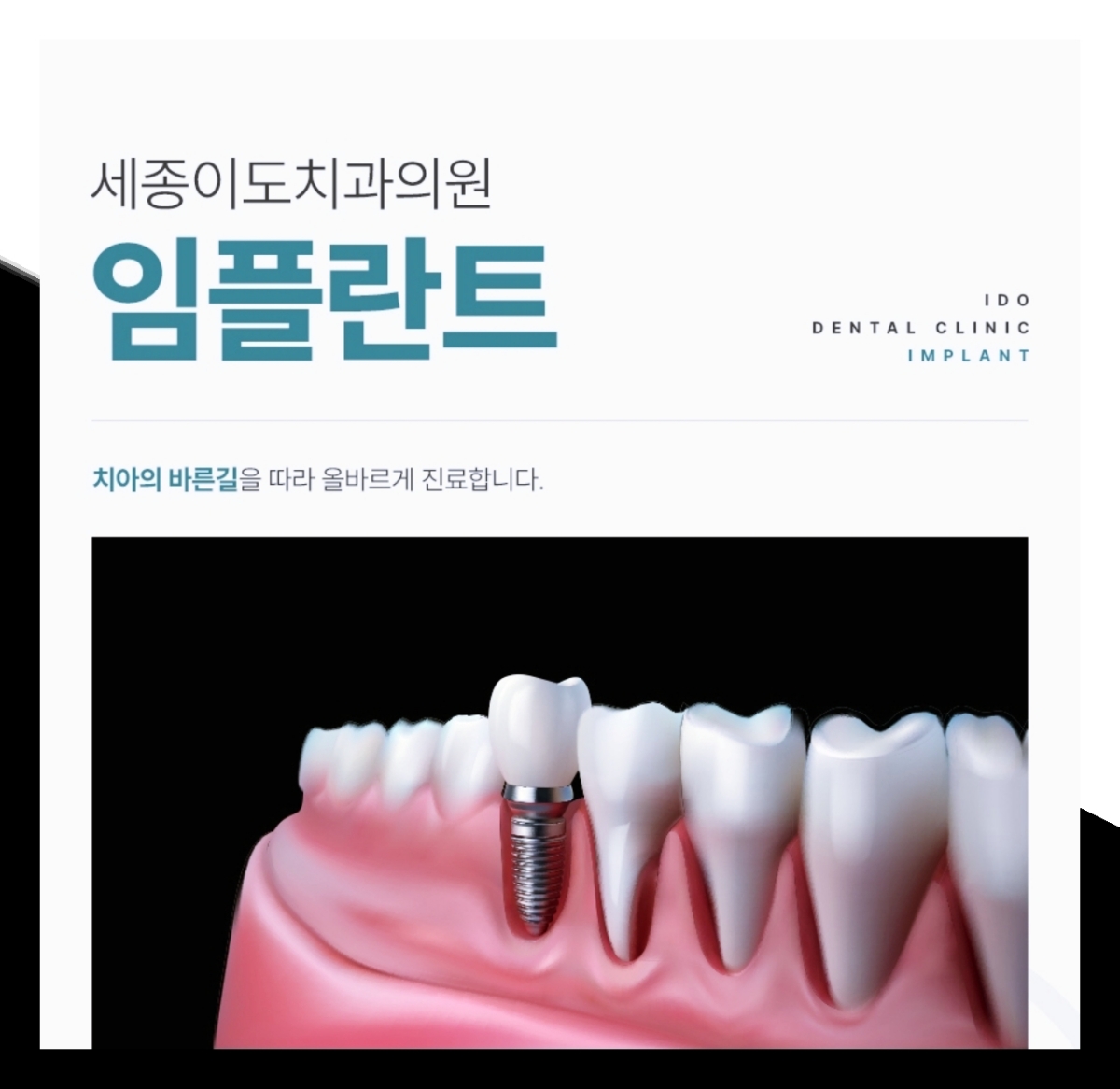 세종치과 임플란트 고민 중이라면 알아두면 좋은 정보 세종치과 임플란트 고민 중이라면 알아두면 좋은 정보
